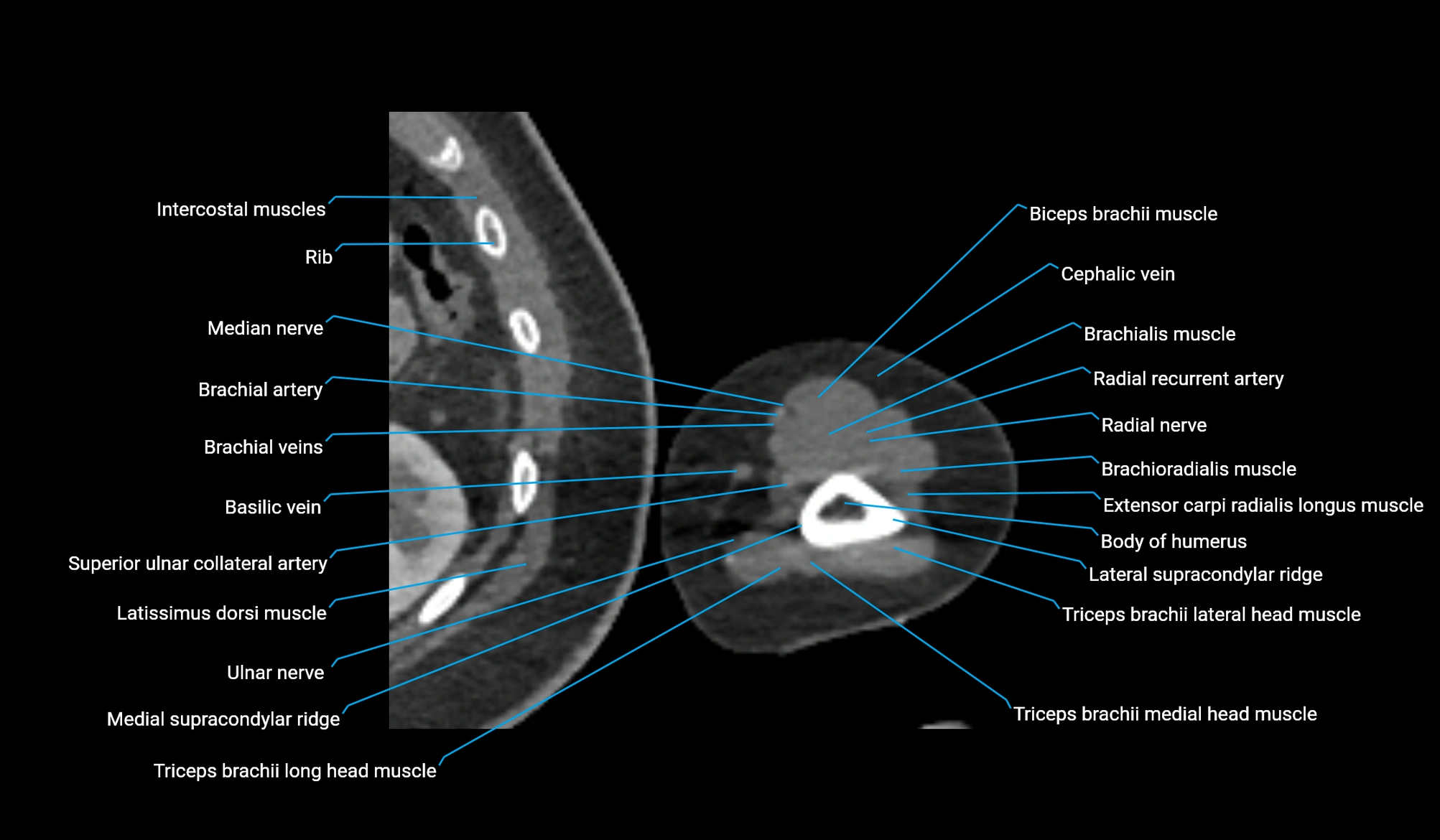 CT upper arm axial  cross sectional anatomy labelled radiology image -00344.webp